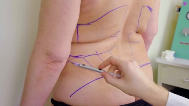 整形术前腹膜成形术标记 以减少腹部和清除脂肪 正确的体形 女性尸体上的外科医生油漆线 — 图库视频影像