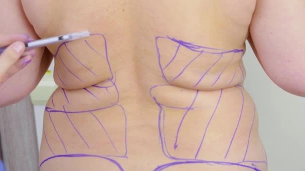 Marcação Abdominoplastia Antes Operação Plástica Para Reduzir Abdômen Remover Celulite — Vídeo de Stock