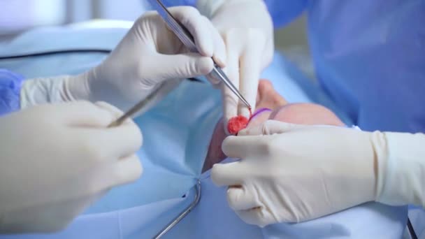 Operasi Bedah Plastik Blepharoplasty Untuk Memodifikasi Bagian Mata Wajah Klinik — Stok Video