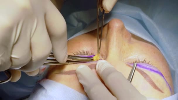Bleferoplastia Îndepărtarea Herniei Mediale Operației Chirurgicale Pleoapelor Superioare Pentru Modificarea — Videoclip de stoc