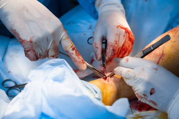 Érsebész Eltávolítja Vénákat Visszeres Műtéthez — Stock Fotó