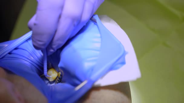 Cofferdam trattamento dentale in stomatologia. Dentista che utilizza diga dentale per l'isolamento dei denti. — Video Stock