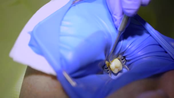 Dental treatment cofferdam in stomatology. Dentiste utilisant une digue dentaire pour l'isolement dentaire. — Video