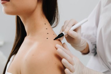 Doktor, migren tedavisi için sırt derisine işaretler çizer. Migrenden kalma bir deri ve terapi için acı.