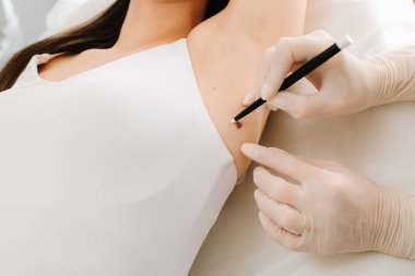 Tıbbi Köstebek Muayenesi. Dermatolojik köstebek incelemesi pigmentasyon ve doku sağlığının doğru değerlendirilmesini sağlar. Dermatologlar lazer çıkarmadan önce bir köstebeği işaretliyorlar.