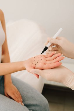 Hiperhidroza karşı bir hastanın avuç içine dolgu yapmak için nokta işaretleme. Hiperhidroz tedavisinin Mark 'ı. Avuç içi terlemesi