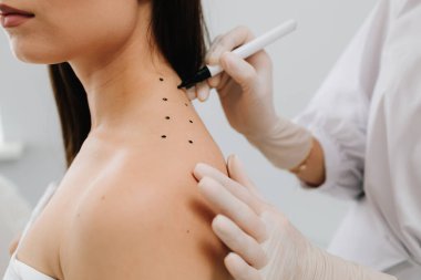 Migrenden kalma deri ve terapi için ağrı kesici. Doktor, migren tedavisi için sırt derisine işaretler çizer.