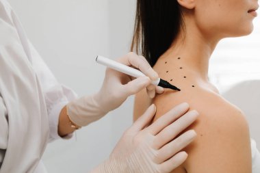 Doktor, migren tedavisi için sırt derisine işaretler çizer. Migrenden kalma bir deri ve terapi için acı.