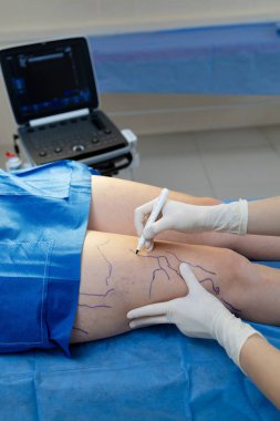 Doktor damar tedavisi için bacak damarlarını özetliyor.