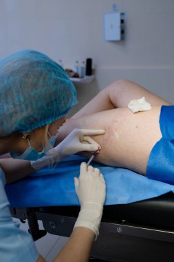 Hasta bacaklarına damar terapisi.