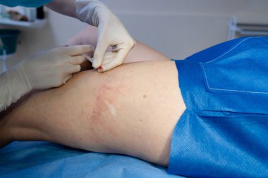 Doktor bacak damarlarını enjeksiyon terapisiyle tedavi ediyor.