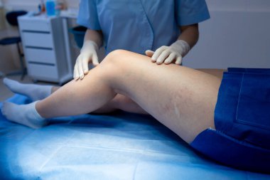 Damar uzmanı bacak damarlarını uyluk çarpıntısıyla ölçüyor.