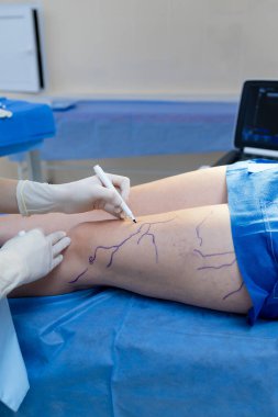 Damar tedavisi planlaması için bacaklara damar işaretleri çiziyorum.