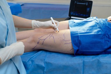 Damar tedavisi planlaması için bacaklara damar işaretleri çiziyorum.