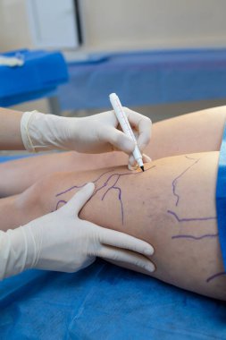 Cerrahi planlama için bacaklarına damar çizen profesyonel bir tıp uzmanı.