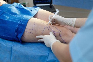 Terapiye hazırlanmak için hasta bacaklarındaki damarları işaretliyorum.