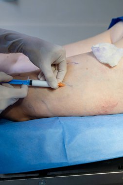 Damar uzmanı, bacak damarı sağlığını iyileştirmek için skleroterapi enjeksiyonu yapıyor.