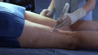 4K video video bacak ultrasonu damar kontrolü için damar cerrahı tarafından. Bacak damarlarının ultrason incelemesi.
