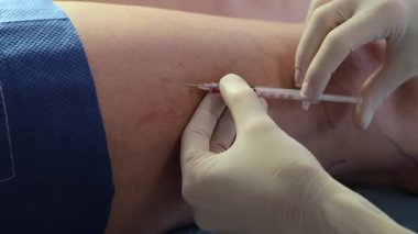 Damar enjeksiyonu videosuyla bacak skleroterapisi. Damar enjeksiyonu damar fonksiyonlarının ve görünüşünün düzelmesine yardımcı olur.