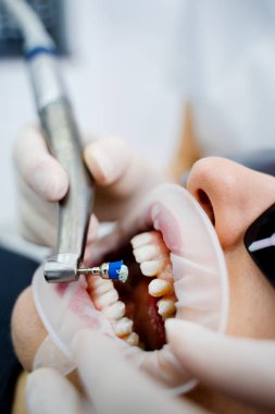 Diş ve diş etleri için dişçi tarafından profesyonel diş temizliği