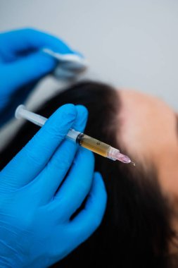 Trikoloğum mikro enjeksiyonlarla kafa derisi mezoterapisi yapıyor.