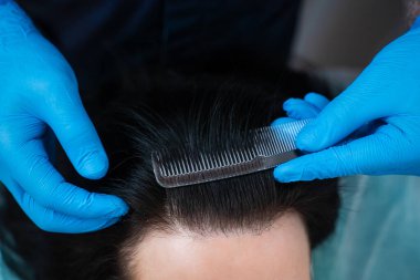 Saç kaybı ve kafa derisi tarağı kullanarak trikoloğun yaptığı değerlendirme.