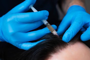 Trichologist saç folikülünü arttırmak için kafa derisi mikro enjeksiyonları uyguluyor.