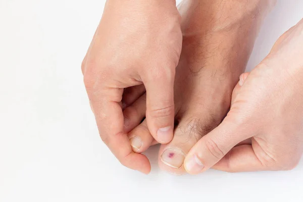 Homem Mostra Uma Contusão Roxa Sob Unha Dedo Fundo Branco — Fotografia de Stock