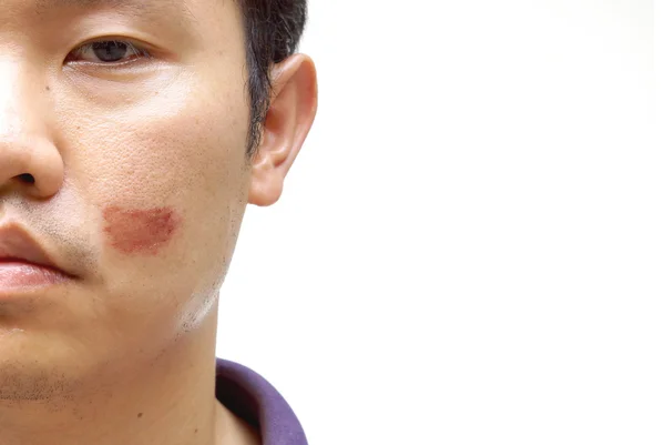 Ανδρικό πρόσωπο με τραυματισμό στο μάγουλο — Φωτογραφία Αρχείου