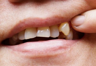 insan köpek dişi giyen