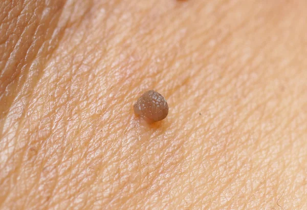 Caucasian  skin with papilloma — Stock Photo, Image