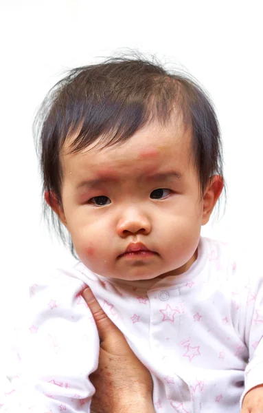 Baby's face with red spots — Stock Photo, Image