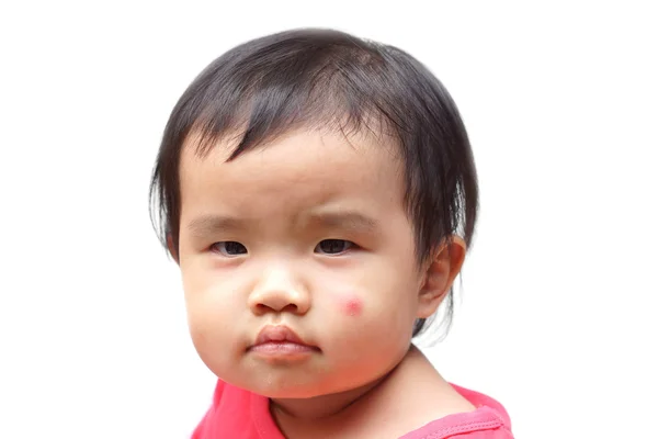 Asian baby with a big red spot — Stock Photo, Image