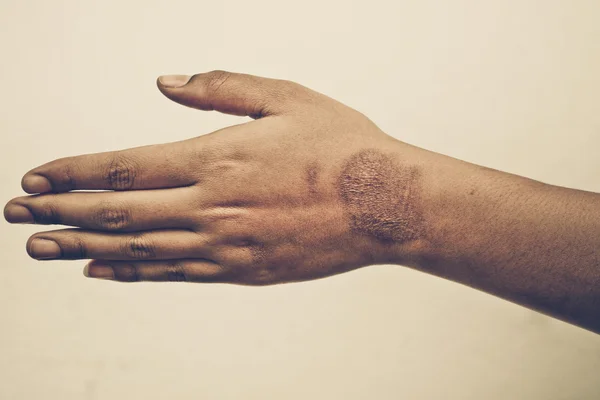 Женская рука со шрамом — стоковое фото