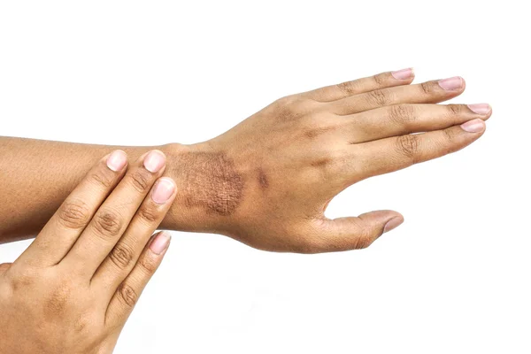 Female hand with wound scar — Stock Photo, Image