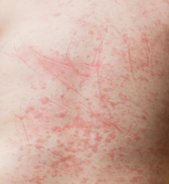 Red spots on baby's skin — Stock Photo, Image