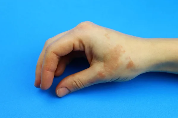 sick hands, dry flaky skin, fungus, rash, blemishes or allergy