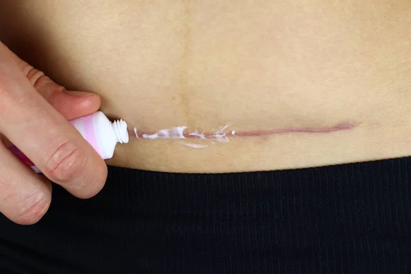 woman applies ointment to the cesarean section scar. The concept of postpartum recovery
