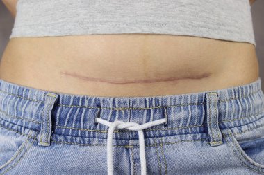 Karnında sezaryen izi olan kız.