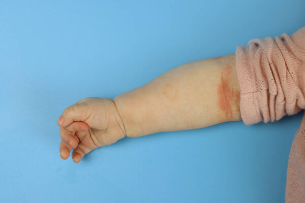 rash on the crease of a child's arm close-up, atopic dermatitis, or food allergy