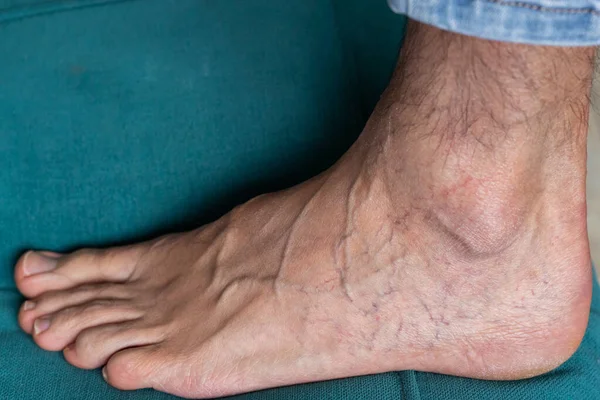Adult man\'s foot with varicose veins