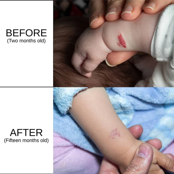 Evolution Angioma Time Baby Arm — Stock Photo, Image