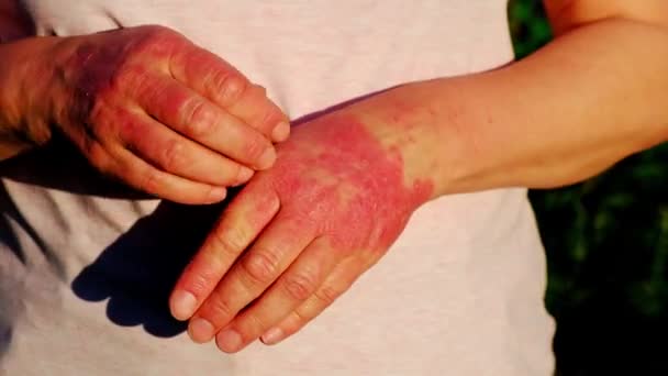 A woman scratches her hands, affected by psoriasis, in the summer in the garden. — Stock Video