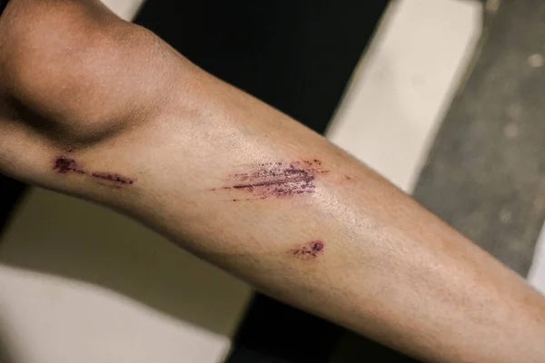 Muchas Lesiones Por Arañazos Accidente Piernas Las Mujeres —  Fotos de Stock