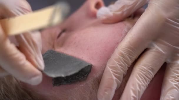 Master Doctor Realiza Procedimiento Eliminación Vello Facial Deseado Hombre Barbudo — Vídeo de stock