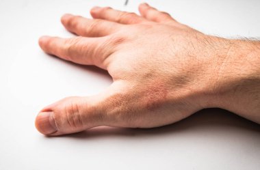 Bir el-gilberts pityriasis yakın plan cilt sorunu döküntüsü.