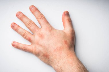 Bir el-gilberts pityriasis yakın plan cilt sorunu döküntüsü.