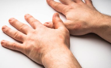 Bir el-gilberts pityriasis yakın plan cilt sorunu döküntüsü.