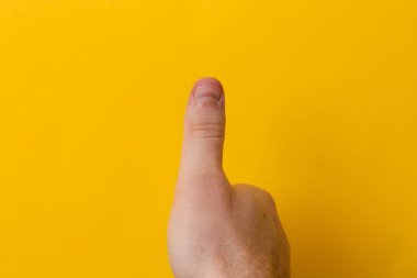 Sarı arka planda yaralı ya da kötü parmak tırnağı. Başparmağını kötü manikürle kapat.