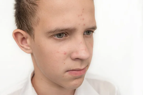 Niño adolescente con acné. Primer plano. Tratamiento facial de la piel. — Foto de Stock